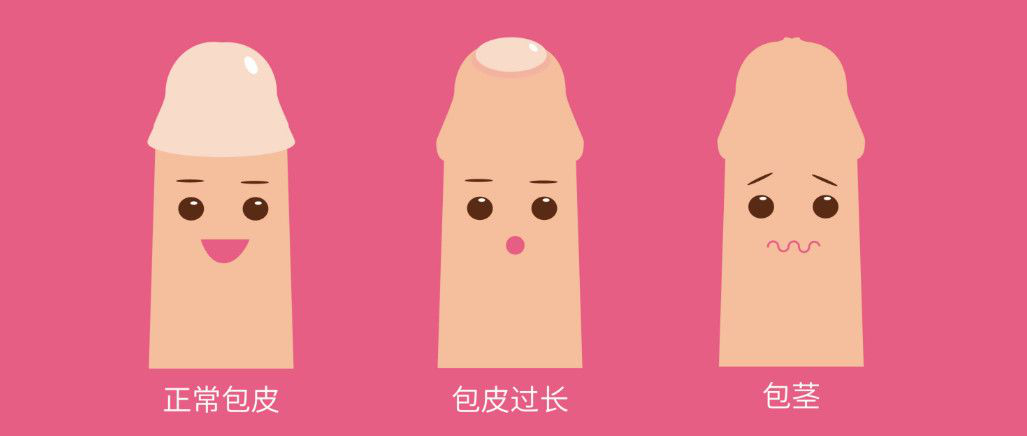 正常小儿包皮和病理性包茎,包皮过长对比图